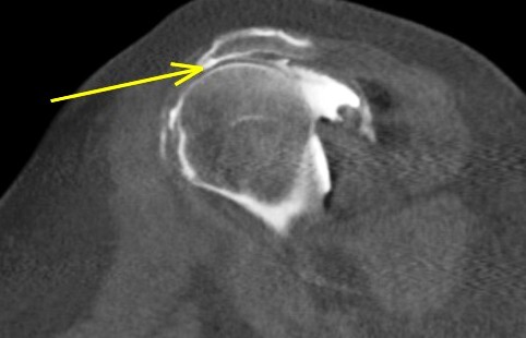 Figure 3 for case Supraspinatus and biceps tendon tears ( RID1953 )( RID1944 )